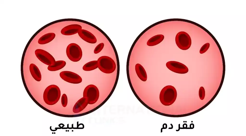 نسبة فقر الدم عند الأطفال
