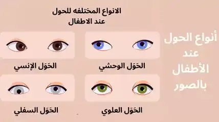 أنواع الحول عند الأطفال بالصور