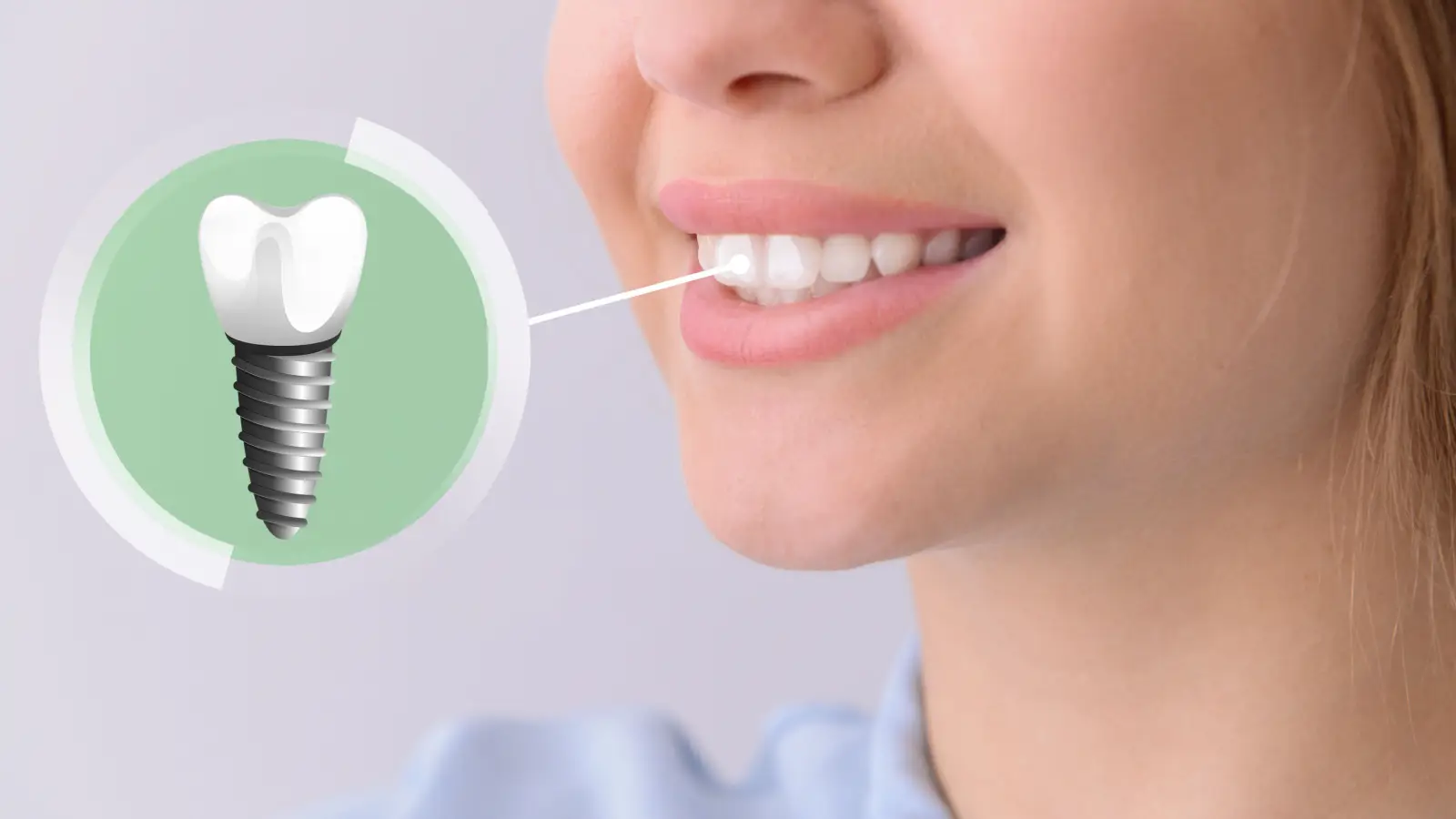 ما هي أهمية تركيبة الأسنان الزيركون؟ وكيفية الحافظ عليها؟