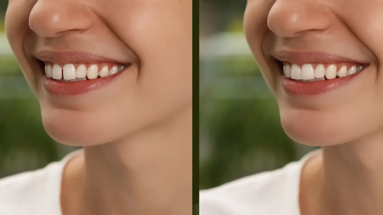 ما هي أفضل طرق تجميل الأسنان الأمامية؟