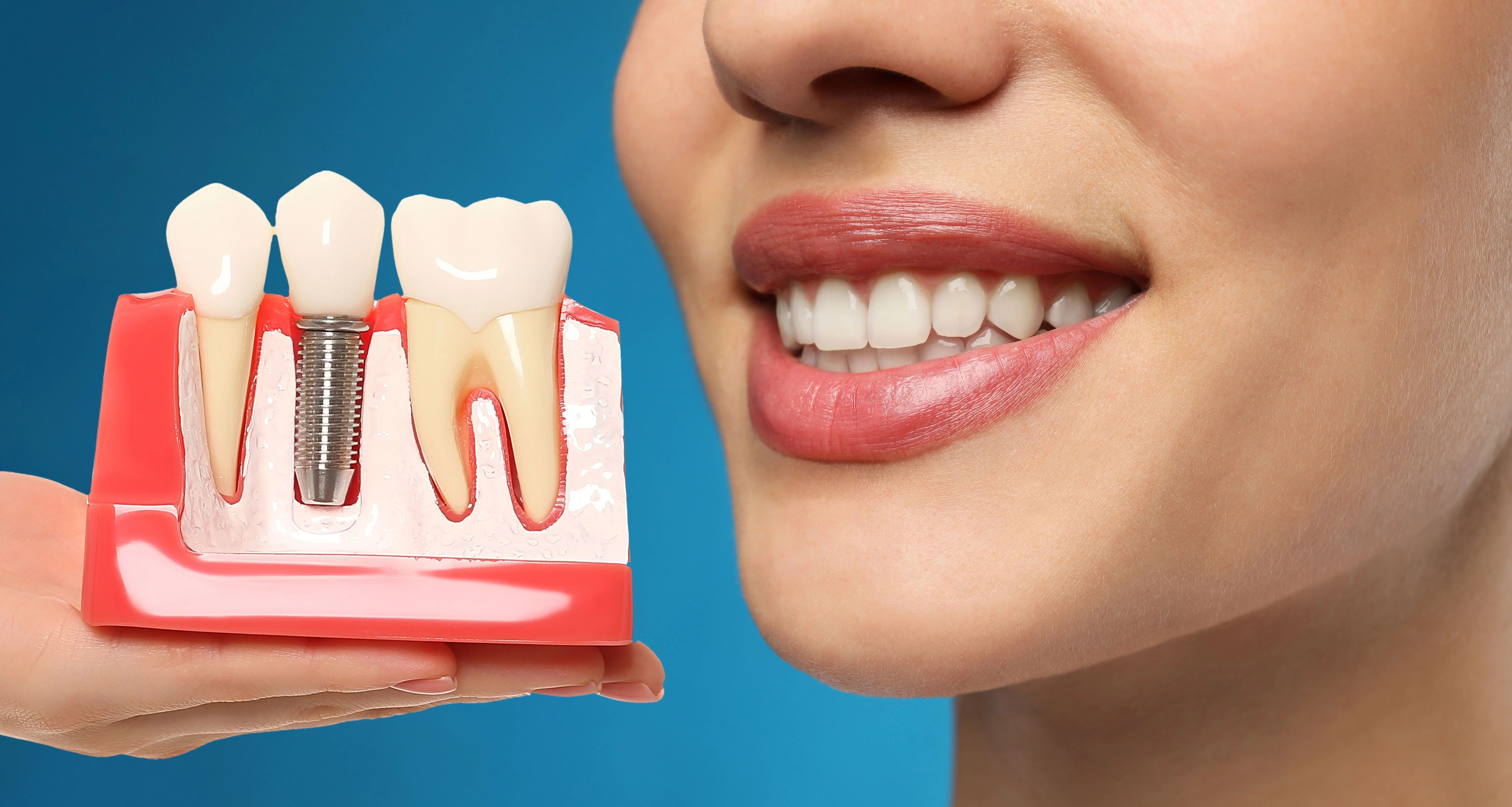 ما هي فترة زراعة الأسنان؟ ومن يحتاج لها؟