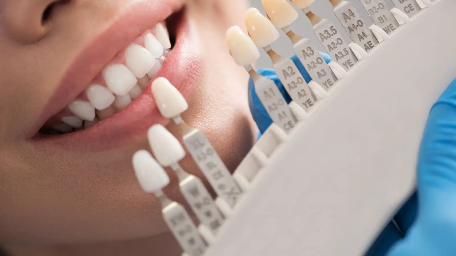 ما هي أفضل أنواع تلبيسات الأسنان؟ وكيف تعتني بها؟