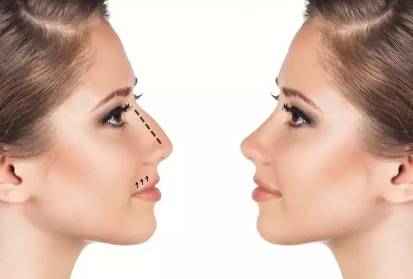 عملية تجميل الأنف
