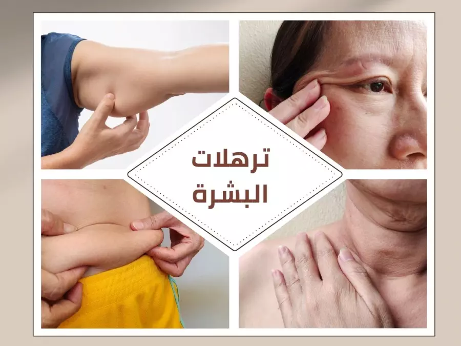 اسباب ترهلات البشرة