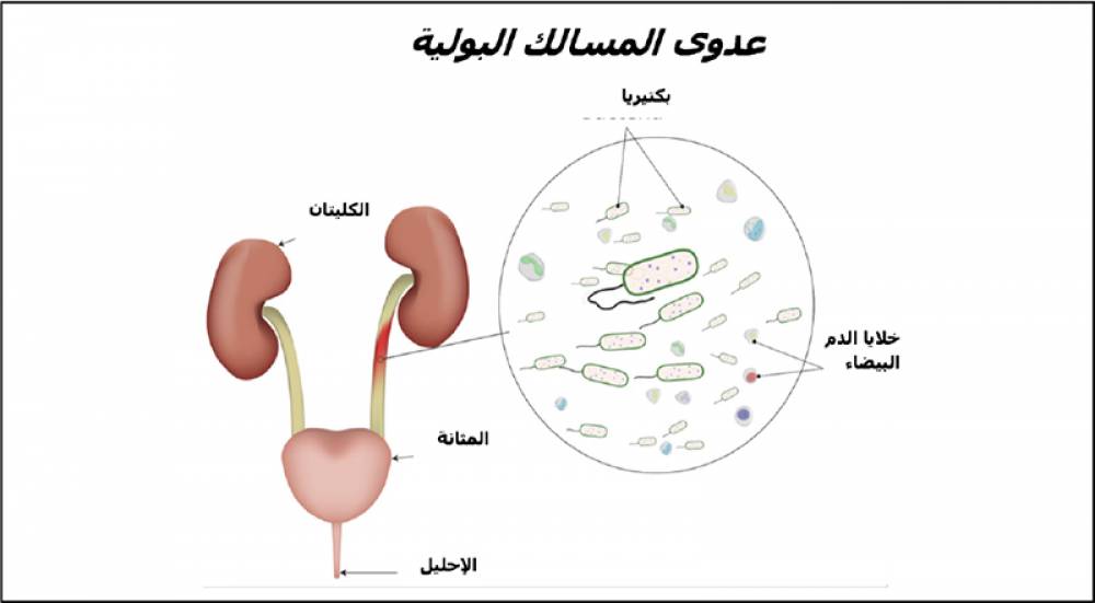 عدوى المسالك البولية