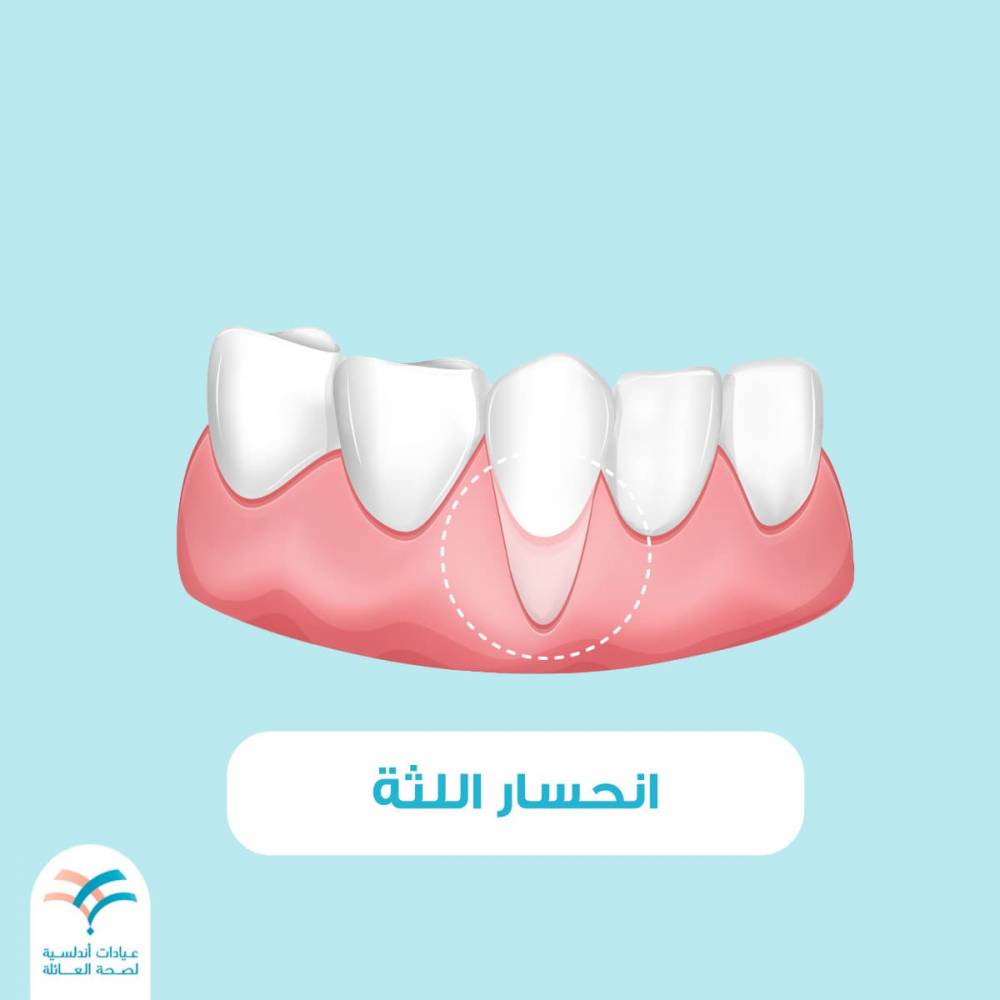 انحسار اللثة