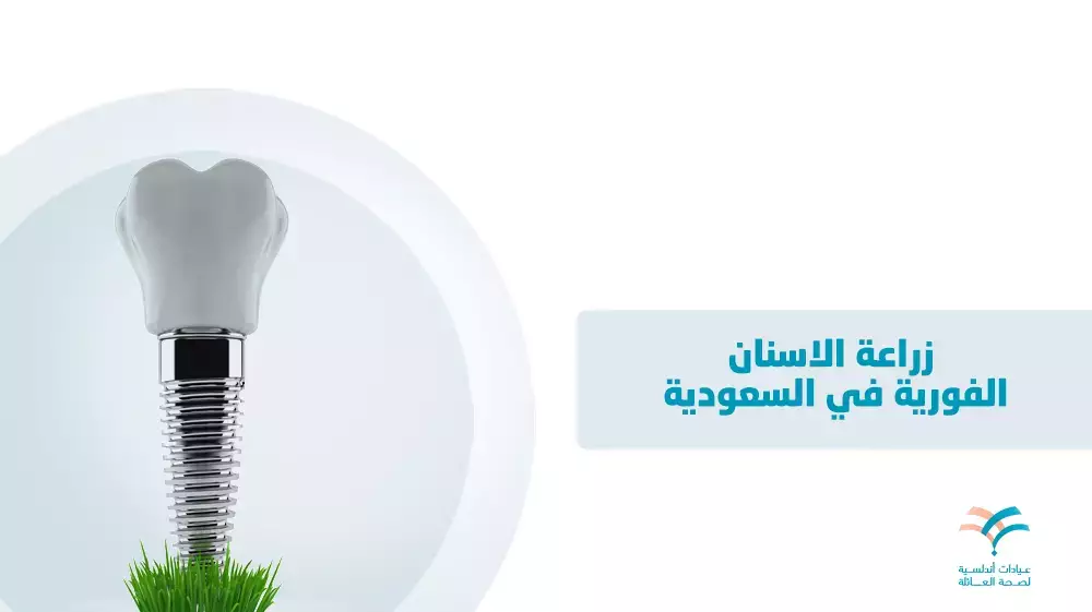 ماذا تعرف عن زراعة الأسنان الفورية في السعودية؟