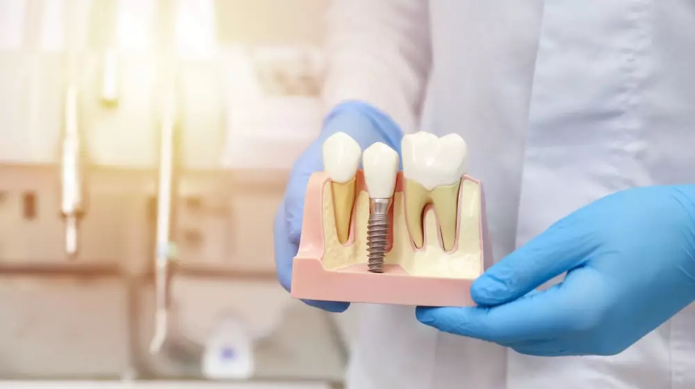 ما هي الزراعة الفورية للأسنان؟ وهل يمكن إجراؤها لمرضى السكر؟