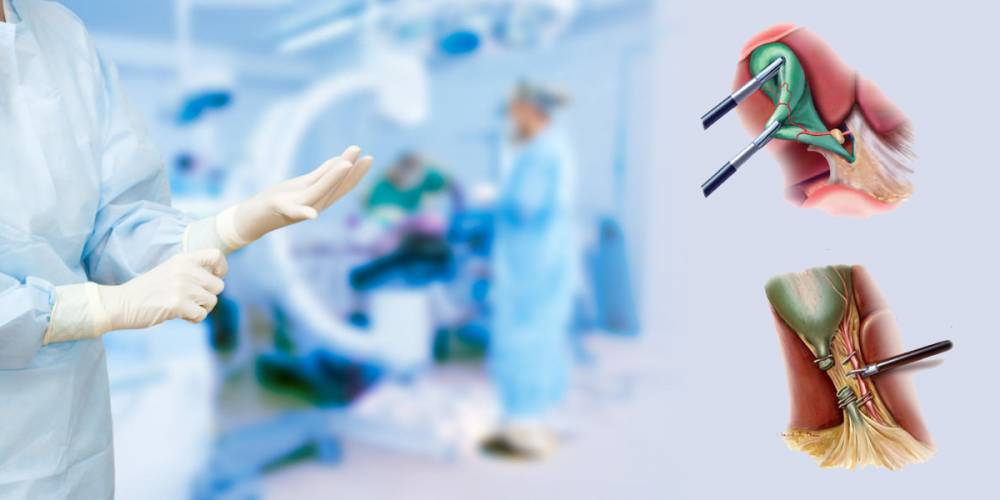 استئصال المرارة