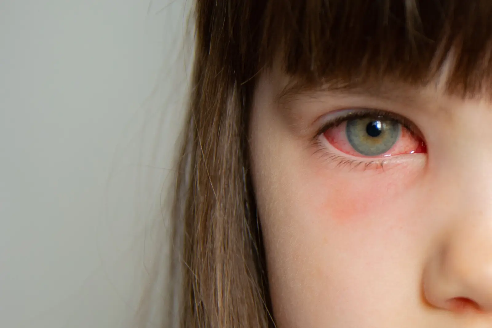 ما هو التهاب ملتحمة العين وكيف يمكن علاجها؟