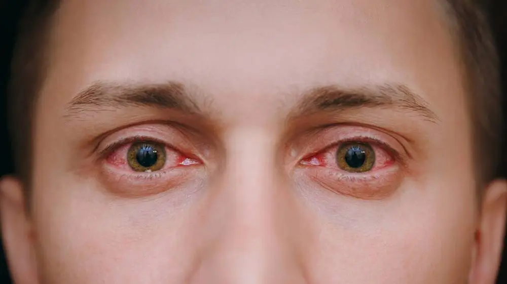 هل يمكن علاج حساسية العين المزمنة؟
