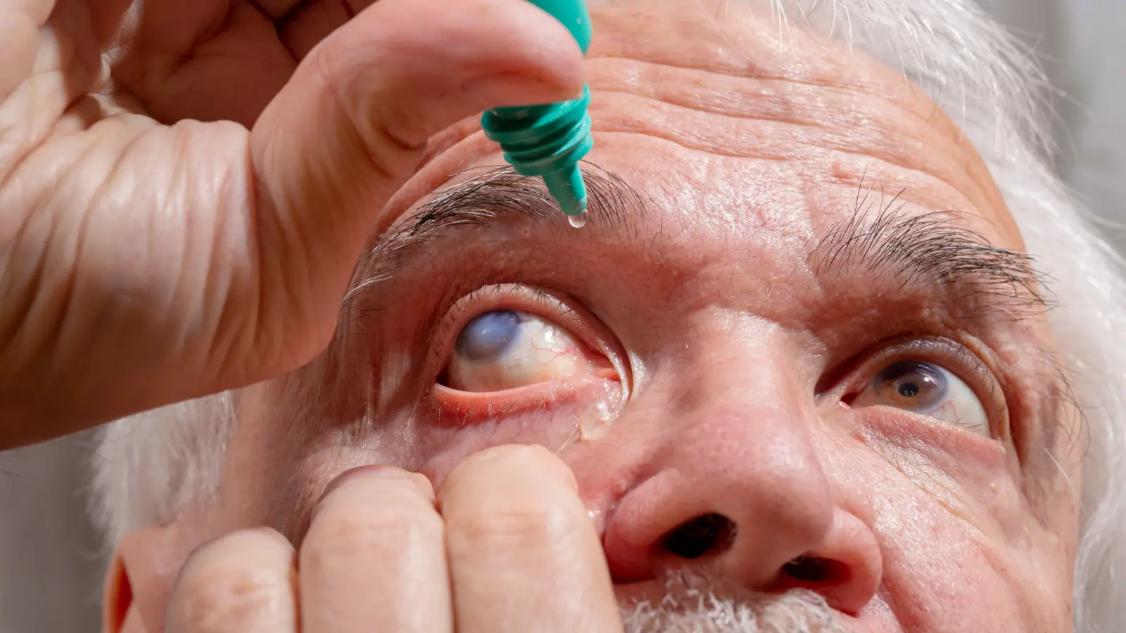 ما هي طرق علاج مرض المياه الزرقاء في العين؟