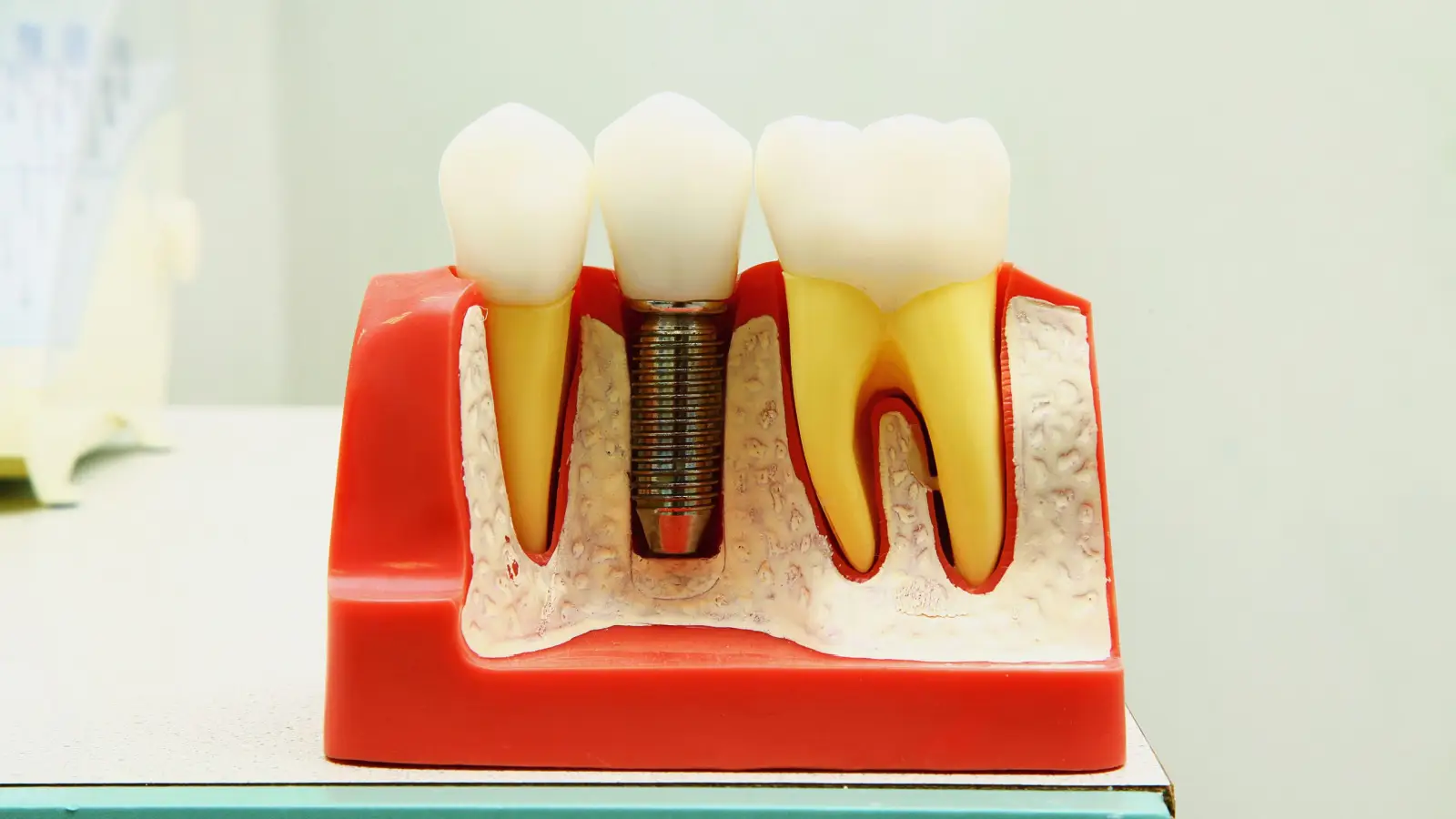 ما هي أنواع وتد الاسنان؟