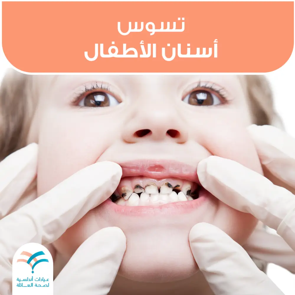كيف يمكن علاج تسوس أسنان الاطفال؟
