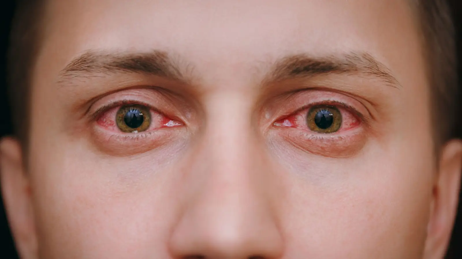 ما هو علاج حساسية العين المزمنة؟