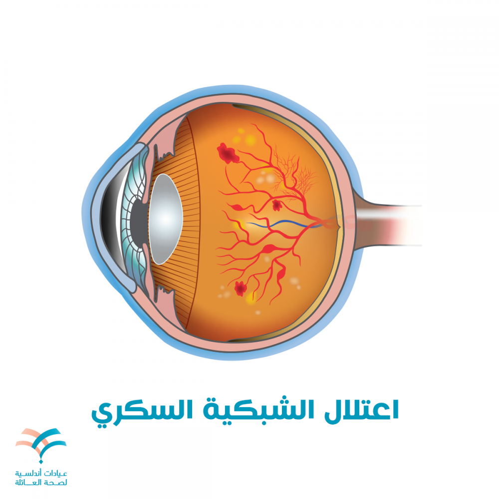 اعتلال الشبكية السكري