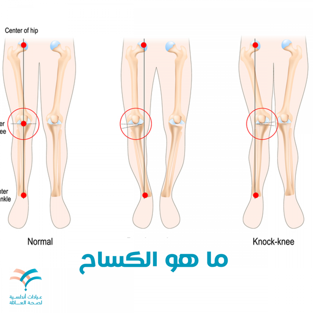 ما هو الكساح