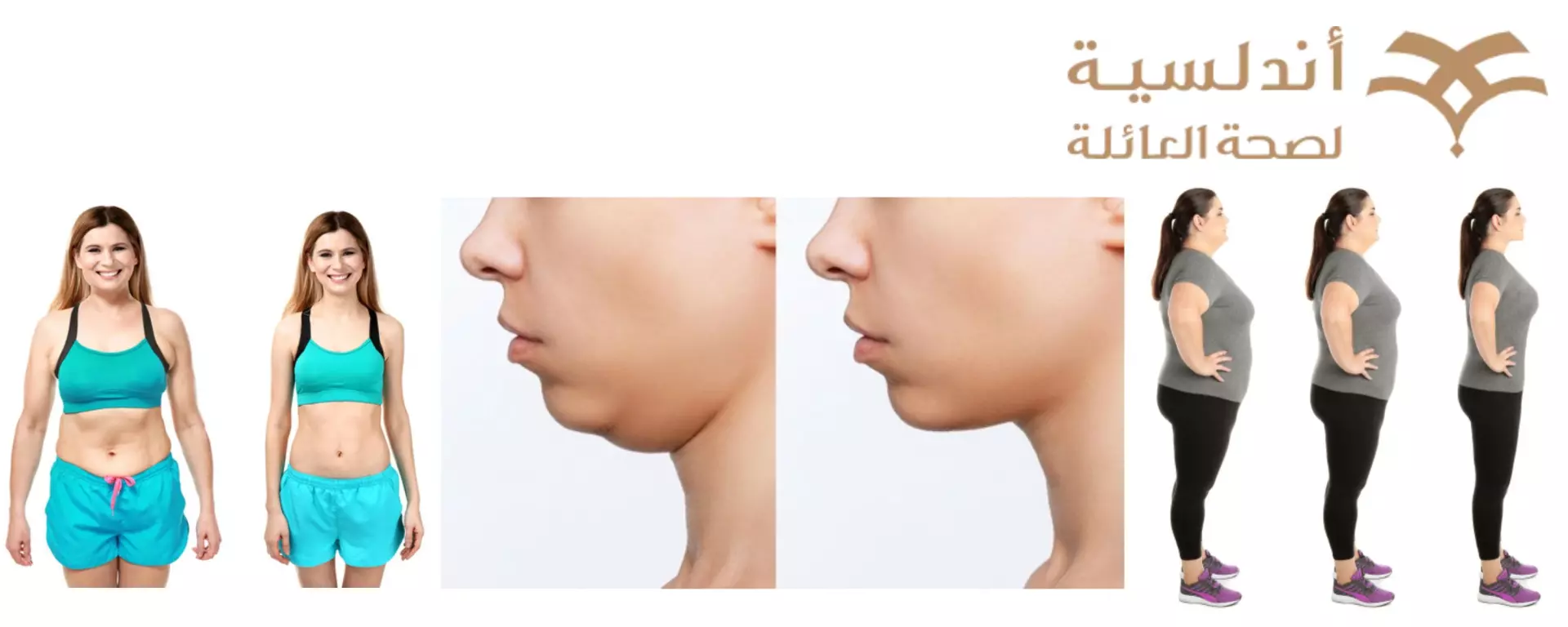 شفط الدهون قبل وبعد