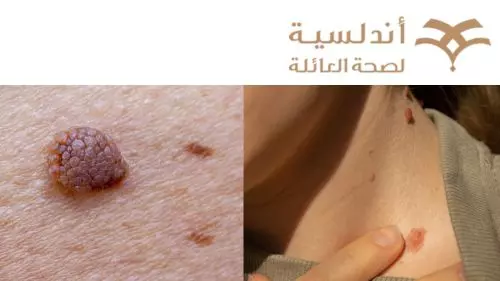 اعراض سرطان الجلد بالصور