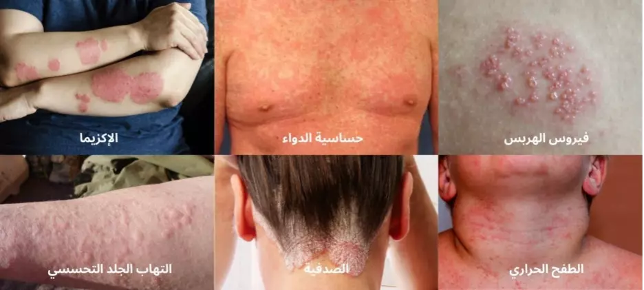 أنواع الطفح الجلدي بالصور