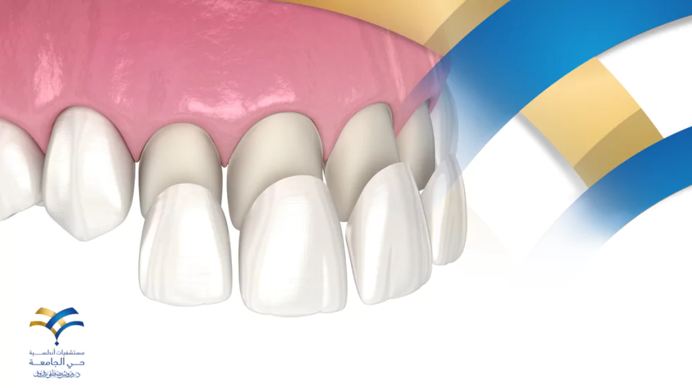 ما هي دواعي تركيب فينير الأسنان وكيف يمكن العناية به؟