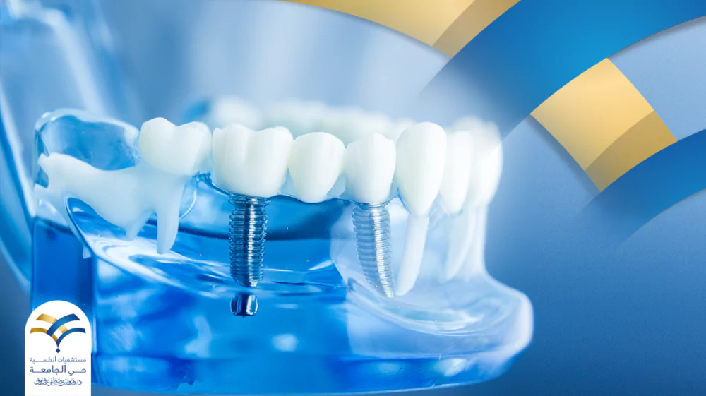 متى يحتاج المريض إلى زراعة الأسنان وما أفضل زرعات الأسنان؟