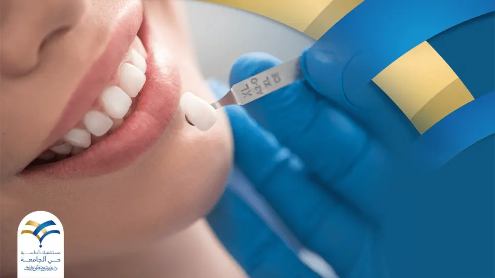 ما أنواع تلبيسات الأسنان وما الفرق بينها ؟