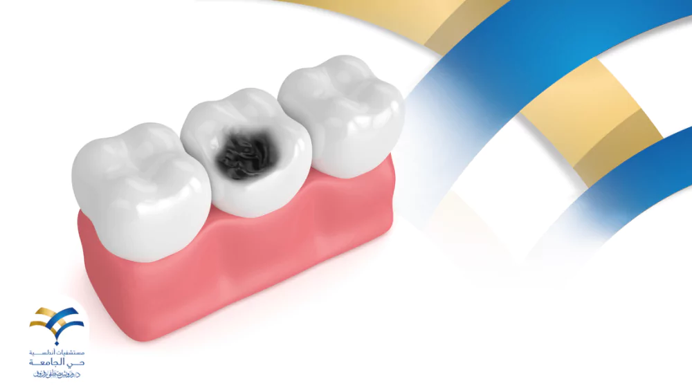 ما هي أعراض تسوس الأسنان Tooth decay وكيفية الوقاية منه؟
