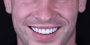 ما هي العدسة اللاصقة للأسنان؟