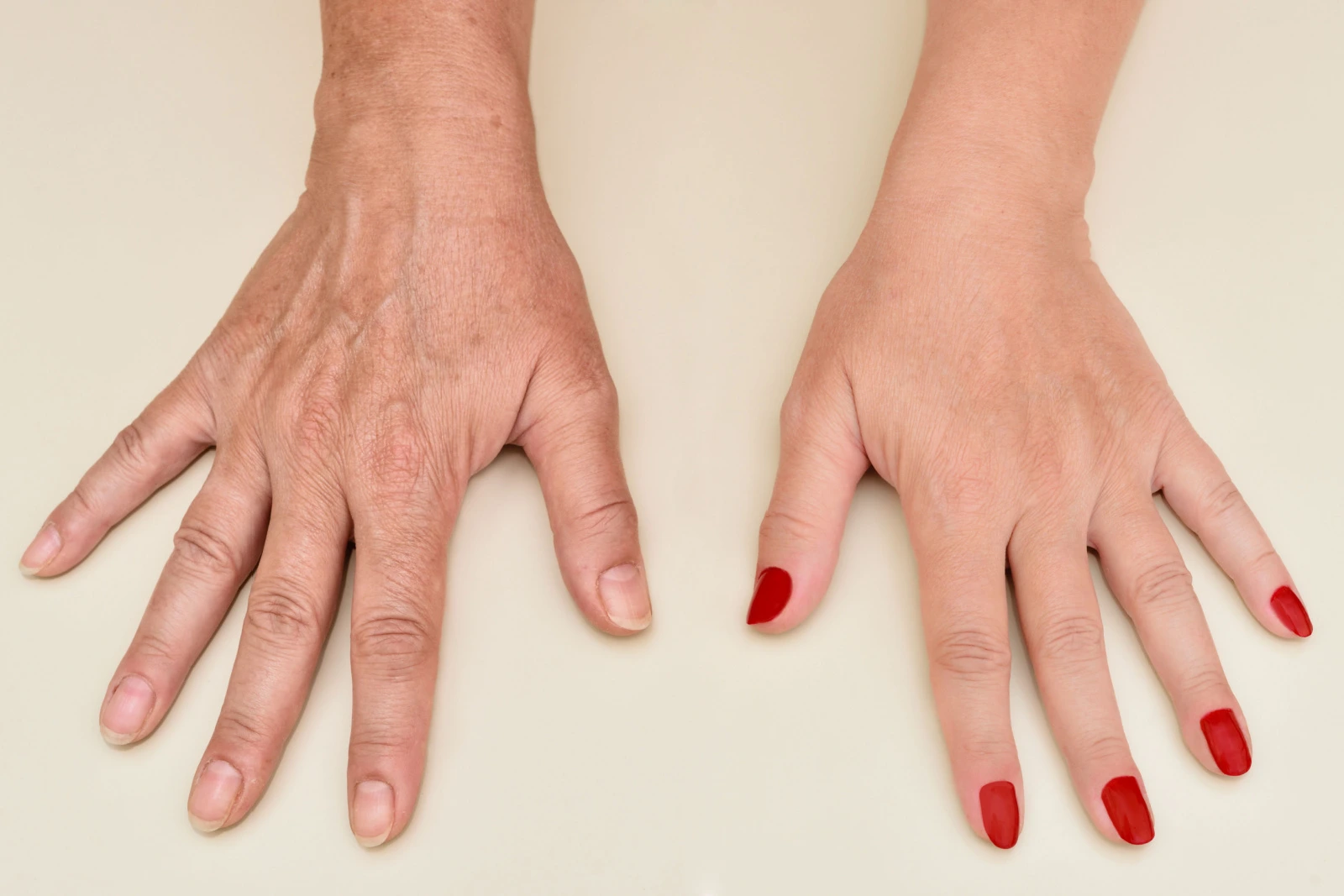 جراحة اليد التجميلية | بين الضرورة والرفاهية