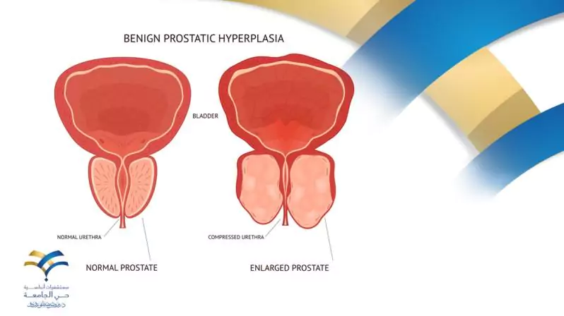 مضاعفات تضخم البروستاتا عند الشباب
