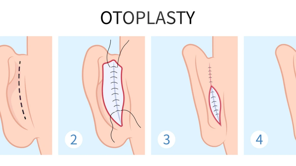  خطوات تجميل الأذن البارزة