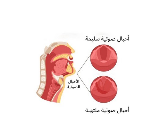 اعراض التهاب الحنجرة بالصور