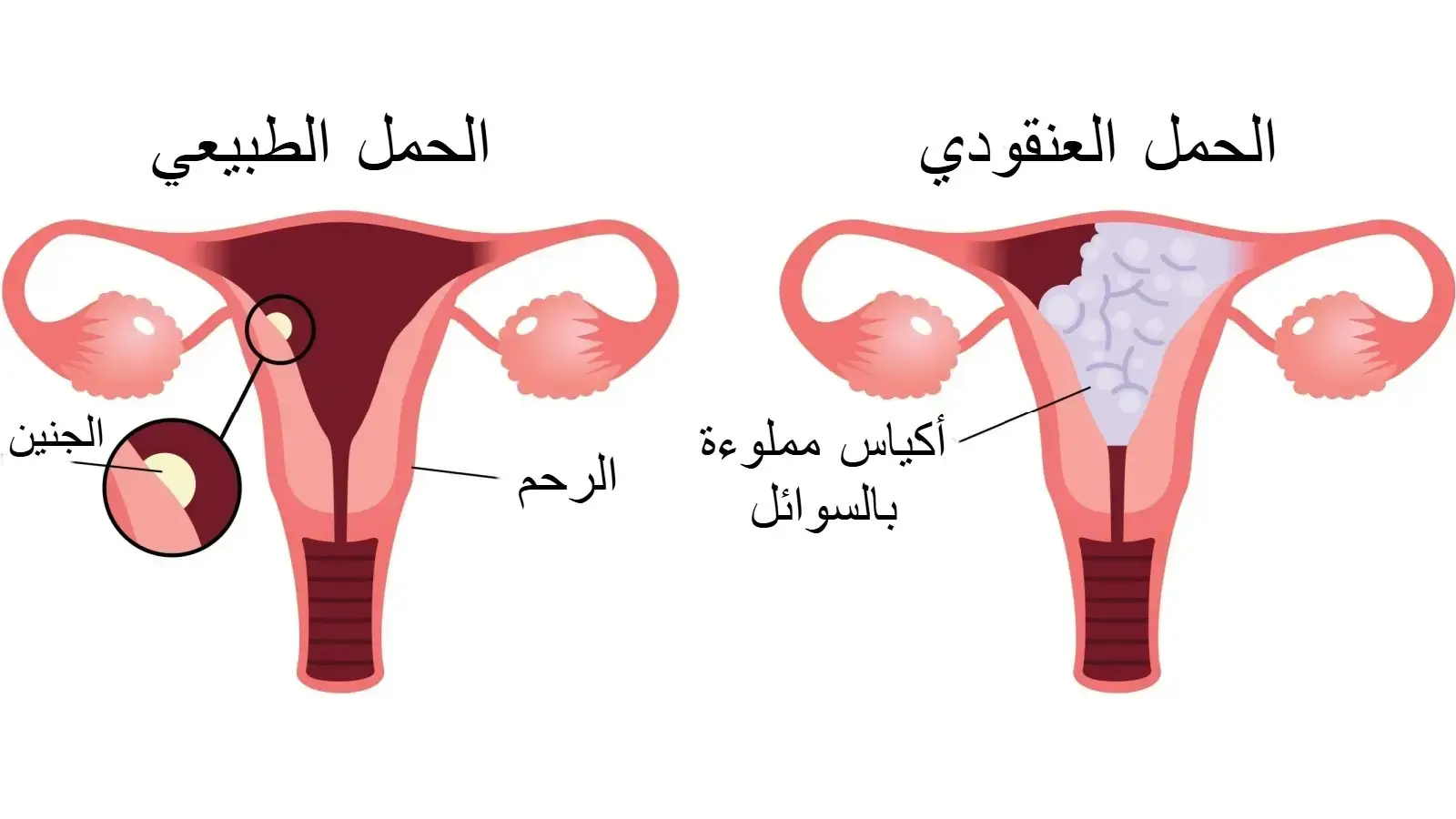 شكل الحمل العنقودي بالصور